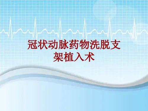手术讲解模板：冠状动脉药物洗脱支架植入术