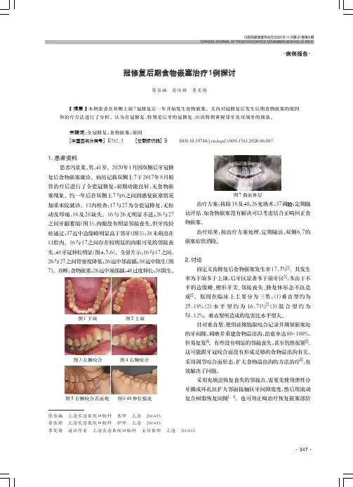 冠修复后期食物嵌塞治疗1例探讨
