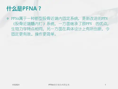 PFNA闭合复位内固定术