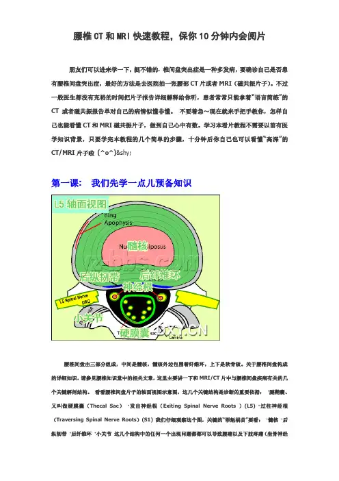腰椎CT和MRI快速教程_保你10分钟内会阅片教材