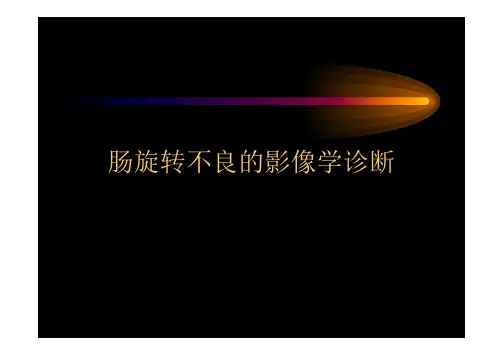 肠旋转不良影像学诊断