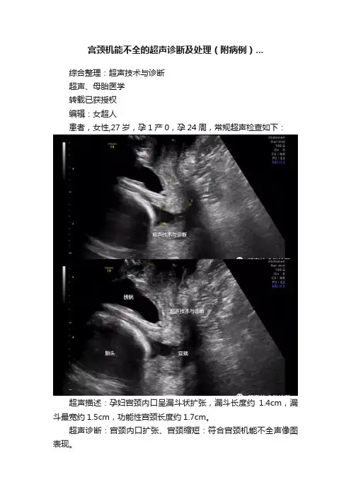 宫颈机能不全的超声诊断及处理（附病例）...