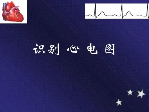 实用心电图(常见异常心电图)-h知识讲解_2022年学习资料