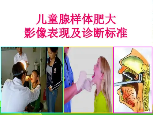 儿童腺样体肥大影像表现及诊断标准-课件