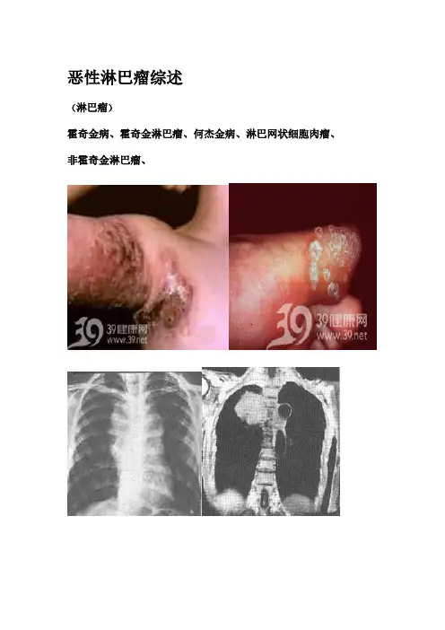 恶性淋巴瘤综述