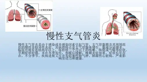 慢性支气管炎PPT【19页】