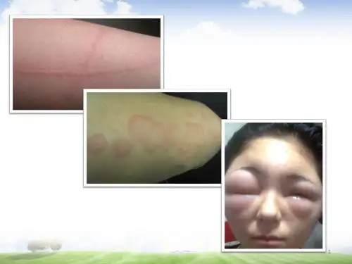 临床免疫学：超敏反应