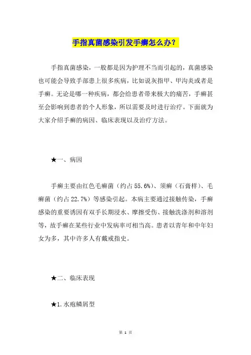 手指真菌感染引发手癣怎么办？