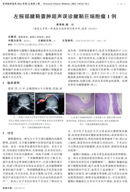左腕部腱鞘囊肿超声误诊腱鞘巨细胞瘤1例