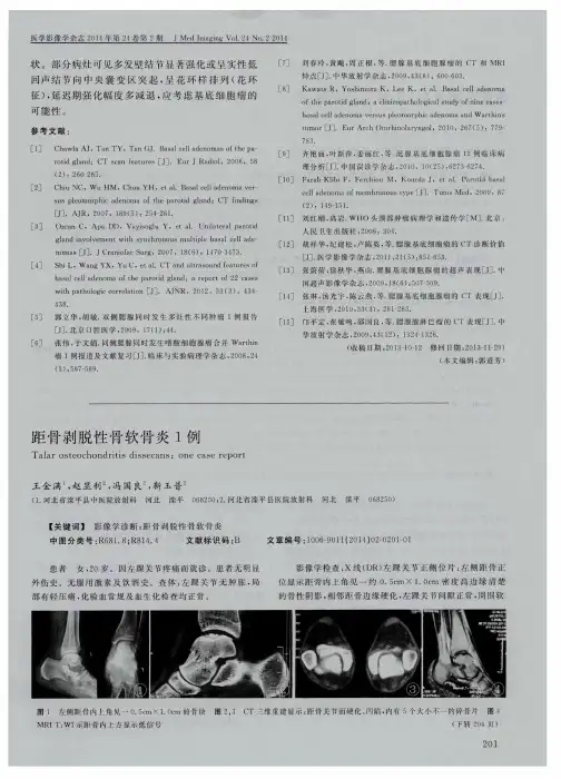 距骨剥脱性骨软骨炎1例