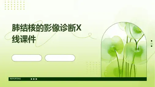 肺结核的影像诊断X线课件