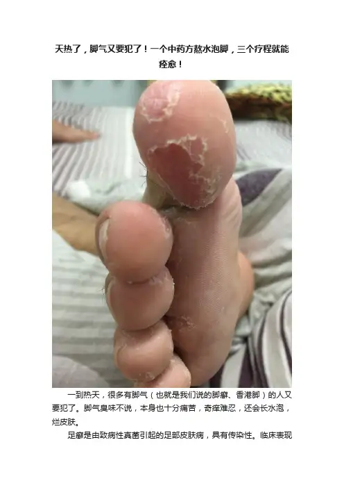 天热了，脚气又要犯了！一个中药方熬水泡脚，三个疗程就能痊愈！