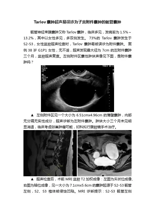 Tarlov囊肿超声易误诊为子宫附件囊肿的骶管囊肿