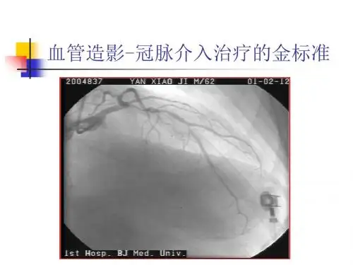 ivus基础知识 ppt课件