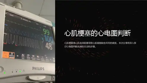 心肌梗塞的心电图判断