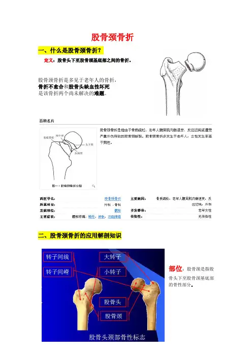 股骨颈骨折