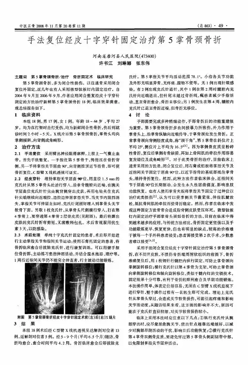 手法复位经皮十字穿针固定治疗第5掌骨颈骨折