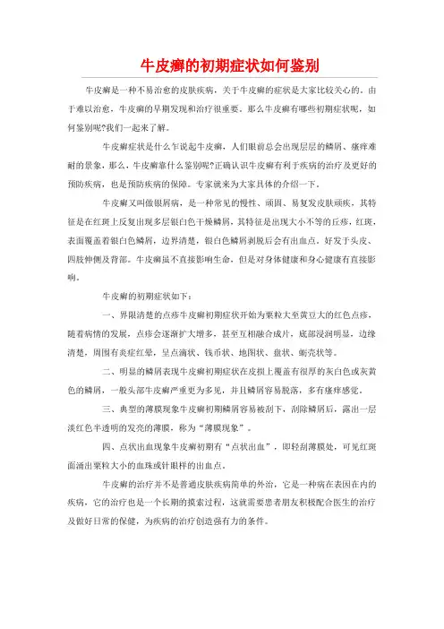 牛皮癣的初期症状如何鉴别