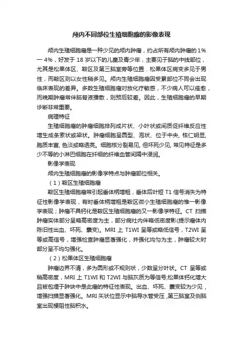 颅内不同部位生殖细胞瘤的影像表现
