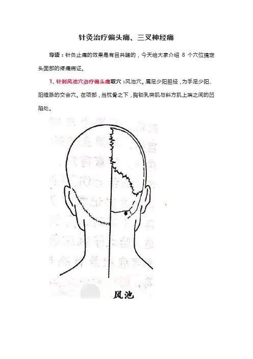 针灸治疗偏头痛、三叉神经痛