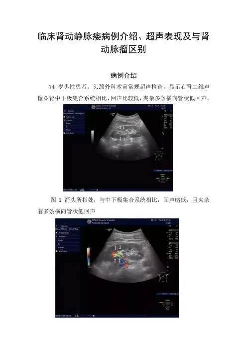 临床肾动静脉瘘病例介绍、超声表现及与肾动脉瘤区别