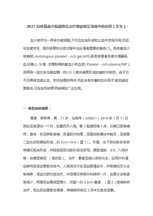2021自体富血小板凝胶在治疗糖尿病足溃疡中的应用(全文)