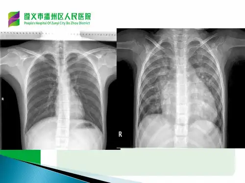 常见先心病血流动力学改变与X线诊断