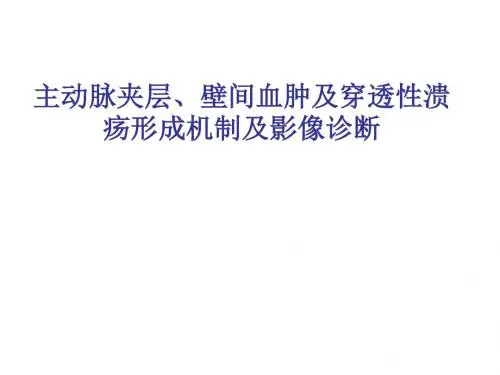 主动脉壁间血肿.ppt
