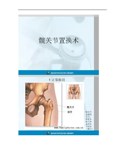 髋关节置换术手术图解讲解