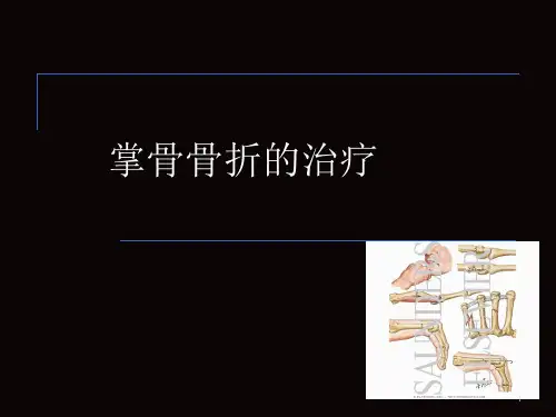 掌骨骨折的治疗精品PPT课件