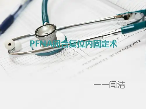 PFNA闭合复位内固定术