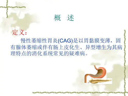 慢性萎缩性胃炎概述