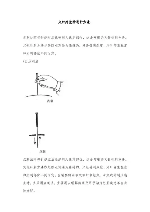 火针疗法的进针方法