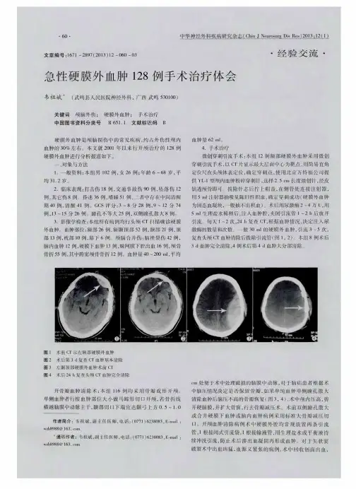 急性硬膜外血肿128例手术治疗体会