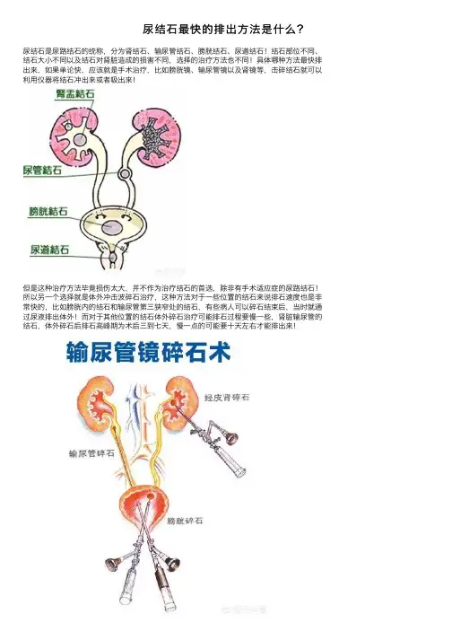 尿结石最快的排出方法是什么？