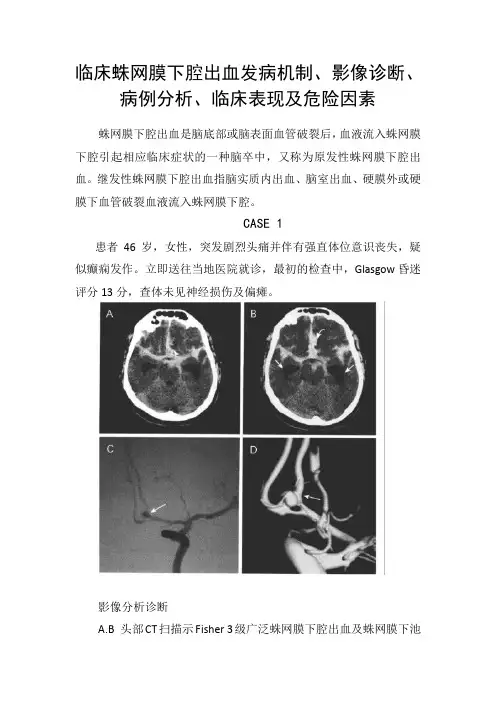 临床蛛网膜下腔出血发病机制、影像诊断、病例分析、临床表现及危险因素