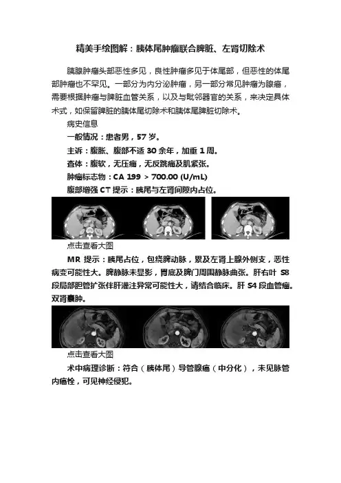精美手绘图解：胰体尾肿瘤联合脾脏、左肾切除术