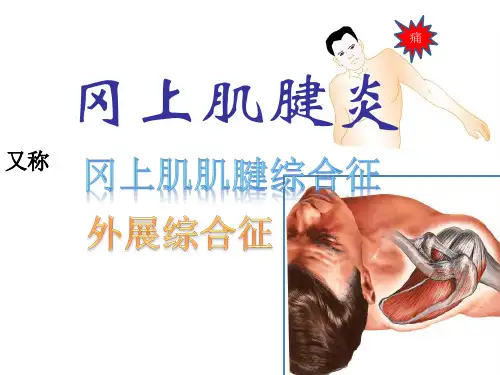冈上肌肌腱炎