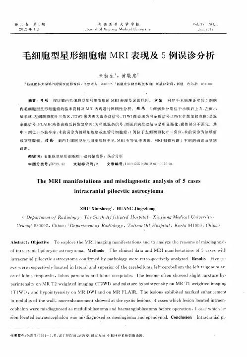 毛细胞型星形细胞瘤MRI表现及5例误诊分析