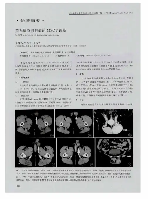 睾丸精原细胞瘤的MSCT诊断