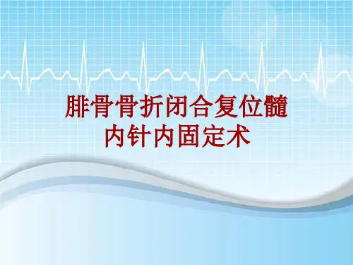 手术讲解模板：腓骨骨折闭合复位髓内针内固定术