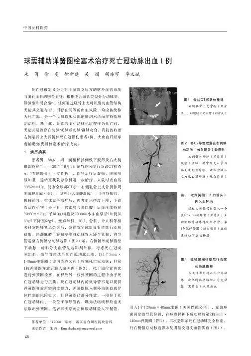 球囊辅助弹簧圈栓塞术治疗死亡冠动脉出血1例