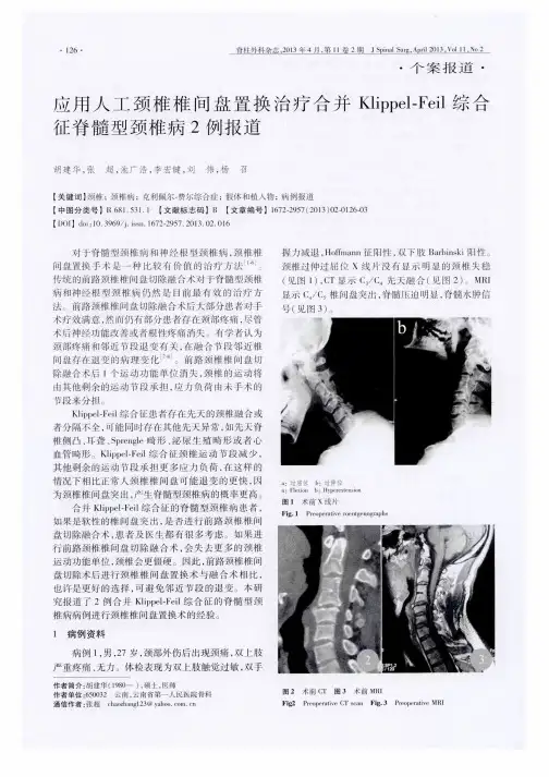 应用人工颈椎椎间盘置换治疗合并Klippel Feil综合征脊髓型颈椎病2例报道