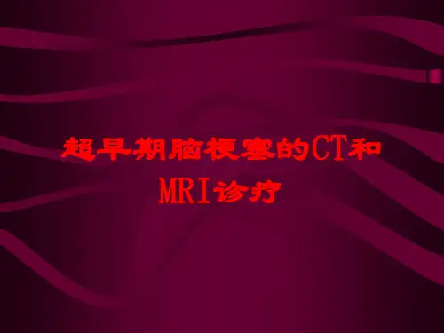 超早期脑梗塞的CT和MRI诊疗培训课件