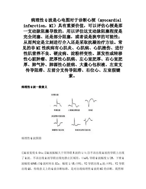 病理性Q波是心电图对于诊断心梗