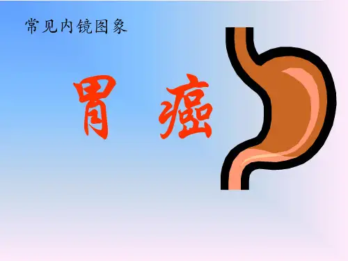 常见内镜图象-胃癌
