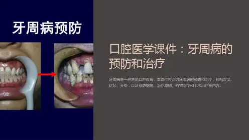 口腔医学课件：牙周病的预防和治疗