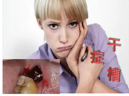 什么叫干槽症