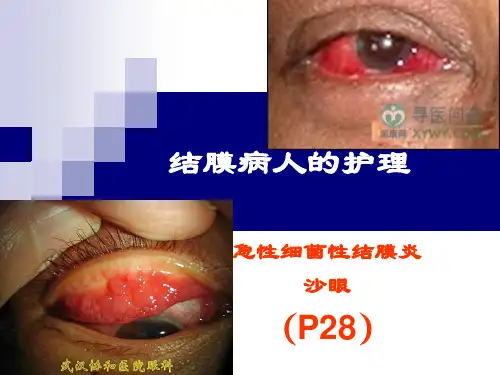 五官科护理学 结膜病人的护理