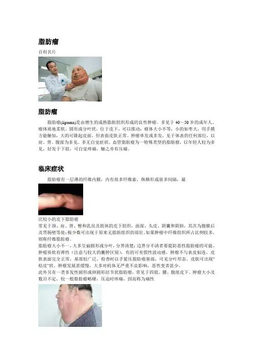 脂肪瘤